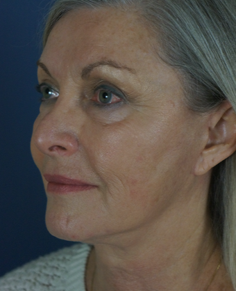 55-64 year old woman treated with Mini Lift after 1816325
