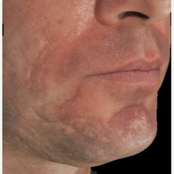 35-44 year old man treated with Infini for Acne Scars Treatment before 1883875