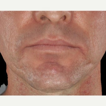 35-44 year old man treated with Infini for Acne Scars Treatment 1883875