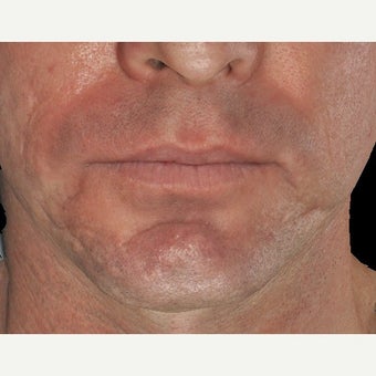 35-44 year old man treated with Infini for Acne Scars Treatment 1883875