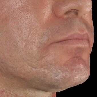 35-44 year old man treated with Infini for Acne Scars Treatment after 1883875