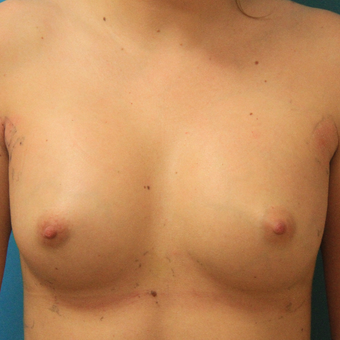 25-34 year old woman treated with Breast Augmentation after 3744060