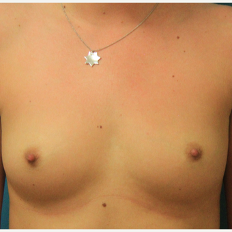 25-34 year old woman treated with Breast Augmentation before 3744060