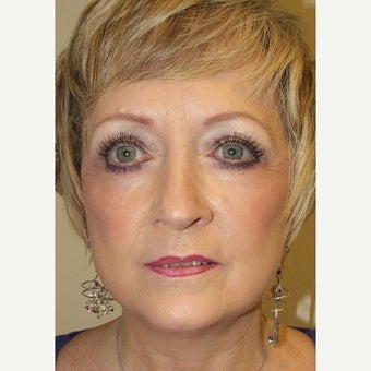 55-64 year old woman treated with Quick Lift after 2487027