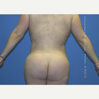45-54 year old woman treated with Body Lift-Circumferential "Belt" lipectomy + Vaser Liposuction after 3041527