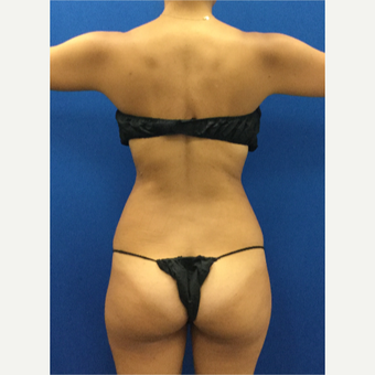 25-34 year old woman treated with Laser Liposuction after 3142279