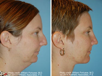 Neck Liposuction before 1389499