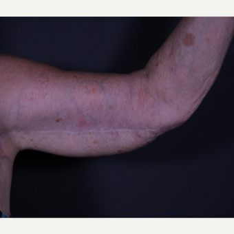 65-74 year old woman treated with Arm Lift after 3101032