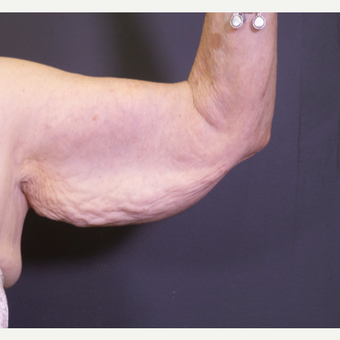 65-74 year old woman treated with Arm Lift before 3101032