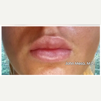 18-24 year old woman treated with Juvederm for Lip Augmentation after 3059011