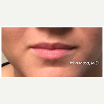 18-24 year old woman treated with Juvederm for Lip Augmentation before 3059011