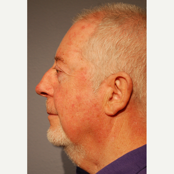 65-74 year old man treated with Neck Lift before 3770203