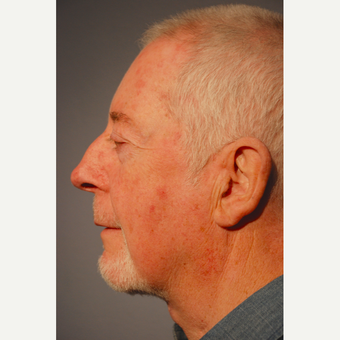 65-74 year old man treated with Neck Lift after 3770203