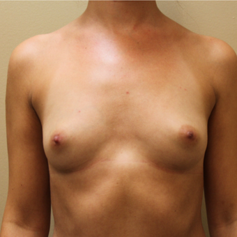Bilateral Transaxillary Subpectoral Breast Augmentation with Silicone Implants before 3418494