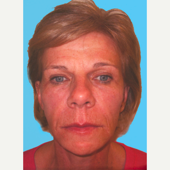Facelift after 3824848
