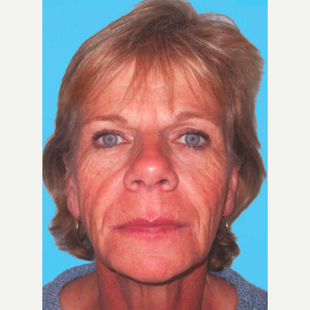 Facelift before 3824848