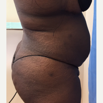 35-44 year old woman treated with Smart Lipo after 3371715