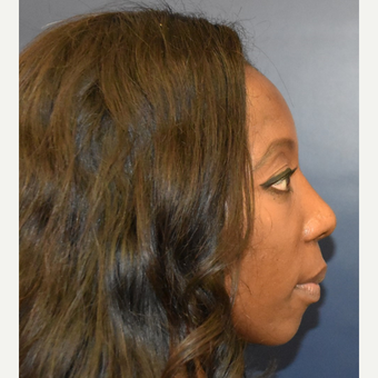 35-44 year old woman treated with Septoplasty after 3289013