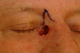 Reconstruction of medial canthus defect before 676940