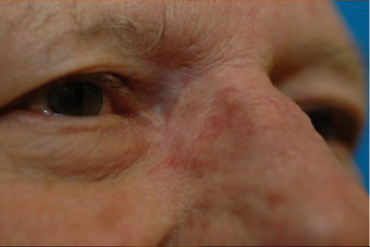 Reconstruction of medial canthus defect after 676940