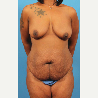 35-44 year old woman treated with Tummy Tuck before 3787071