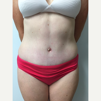 41 year old woman treated with Tummy Tuck and Liposuction after 3822277