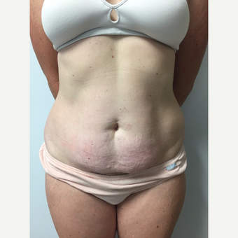 41 year old woman treated with Tummy Tuck and Liposuction before 3822277