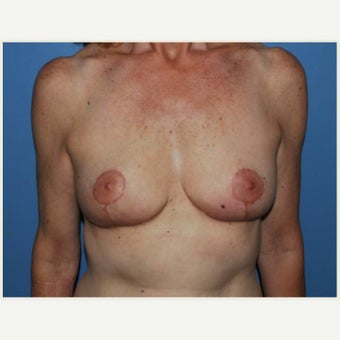 55-64 year old woman treated with Breast Lift after 1657660
