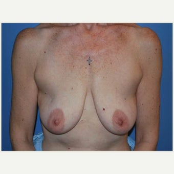55-64 year old woman treated with Breast Lift before 1657660