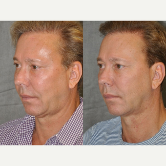 55-64 year old man treated with Facelift before 3181906