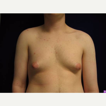18-24 year old man treated with Male Breast Reduction before 3711752
