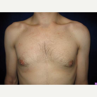 18-24 year old man treated with Male Breast Reduction after 3711752