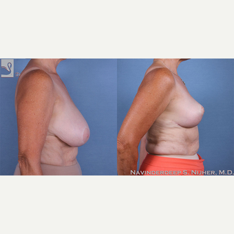55-64 year old woman treated with Breast Reduction after 3770057