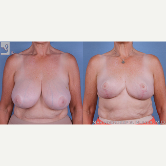 55-64 year old woman treated with Breast Reduction before 3770057