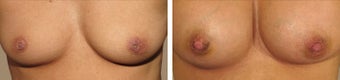 inverted nipple correction before 1371764