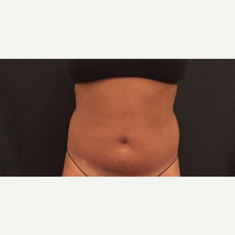 65-74 year old woman treated with CoolSculpting before 3747956