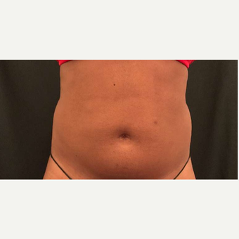 65-74 year old woman treated with CoolSculpting after 3747956