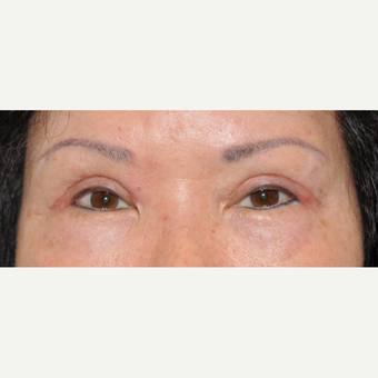 65-74 year old woman treated with Asian Eyelid Surgery after 3508753