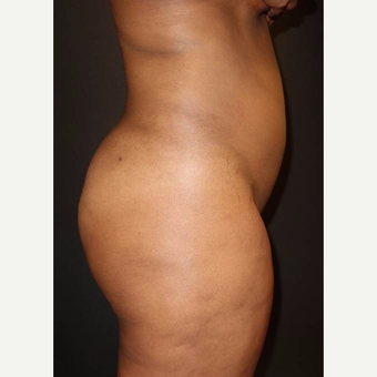 25-34 year old woman treated with Brazilian Butt Lift after 3458001
