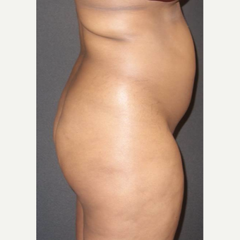 25-34 year old woman treated with Brazilian Butt Lift before 3458001