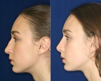 Nose Surgery before 1430588