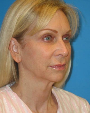 56 year old woman treated for neck obliquity, short chin, jowls before 1351645