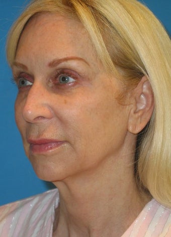 56 year old woman treated for neck obliquity, short chin, jowls 1351645