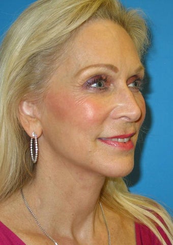 56 year old woman treated for neck obliquity, short chin, jowls after 1351645
