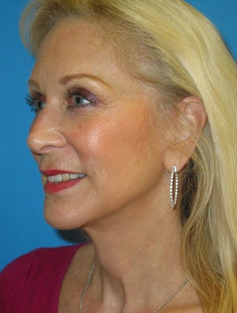 56 year old woman treated for neck obliquity, short chin, jowls 1351645