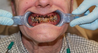 All-on-4 Dental Implants before 1288250