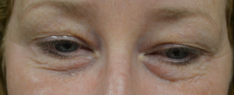 45-54 year old woman treated with Eye Bags Treatment before 3287772