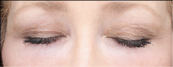 45-54 year old woman treated with Eye Bags Treatment after 3287772