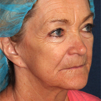 67 year old woman treated one time with CO2 Laser before 3630325