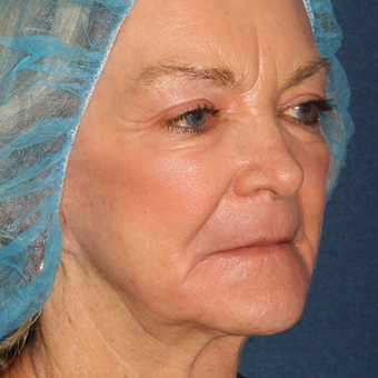 67 year old woman treated one time with CO2 Laser after 3630325